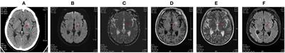 Hemichorea Associated With Non-ketotic Hyperglycemia: A Case Report and Literature Review